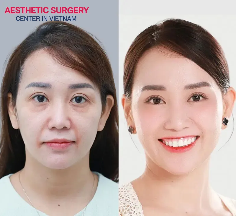 The results of a Facelift procedure will become noticeable after a few weeks.