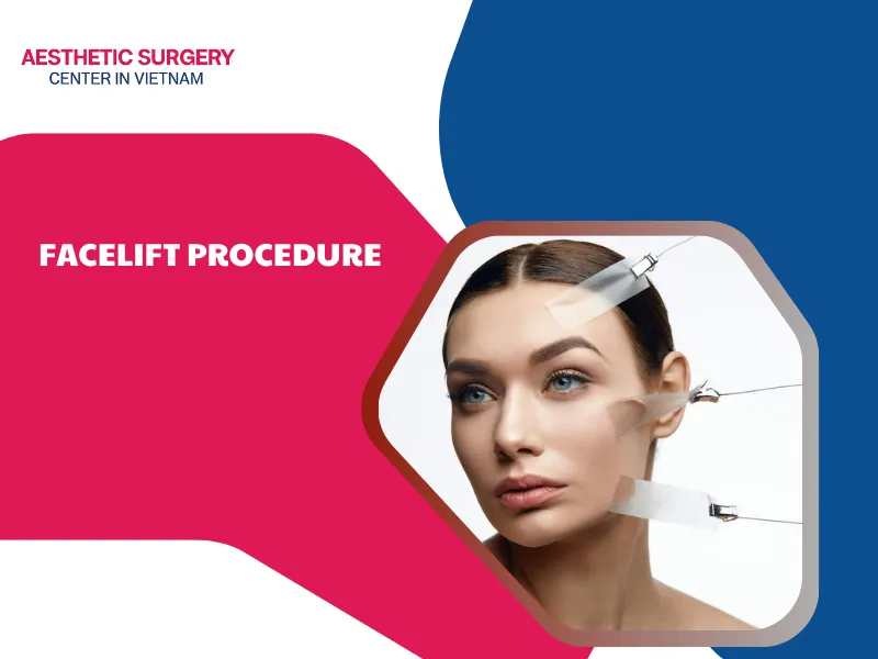 facelift procedure