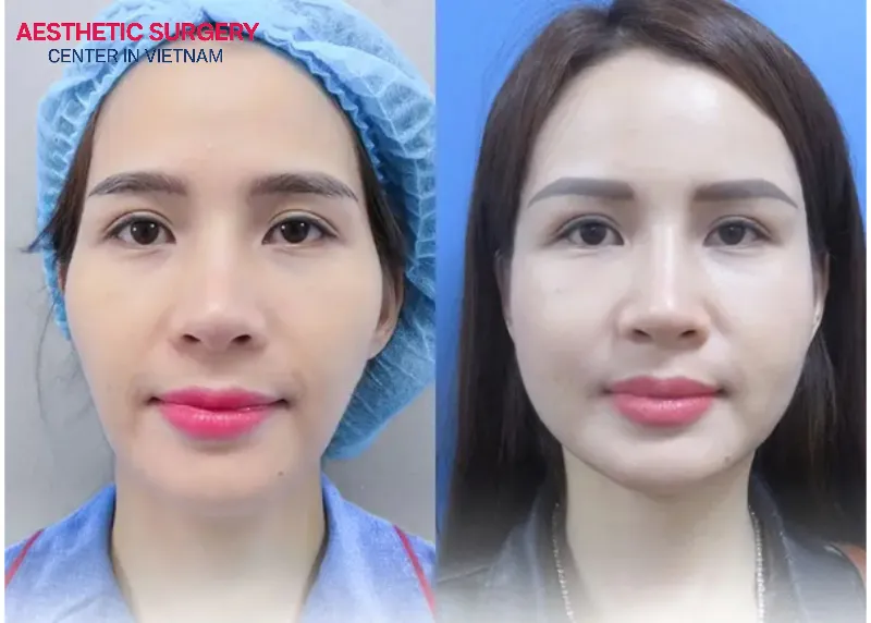 Fat grafting with a facelift helps give her a more youthful and refreshed appearance.