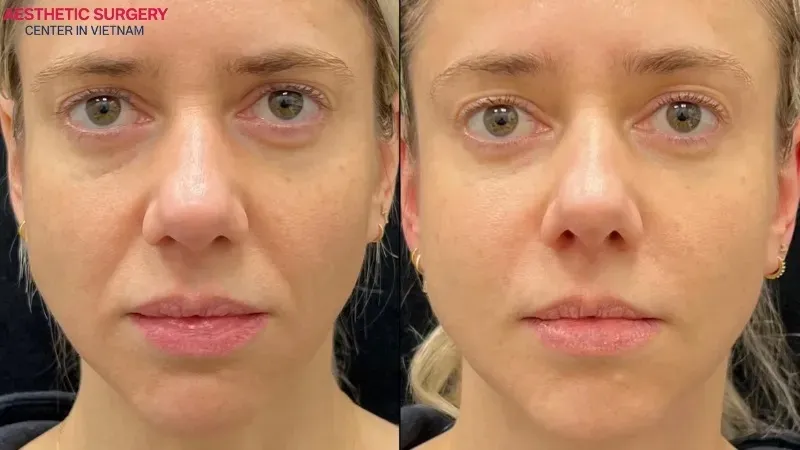 The noticeable transformation on the face after filler injections.
