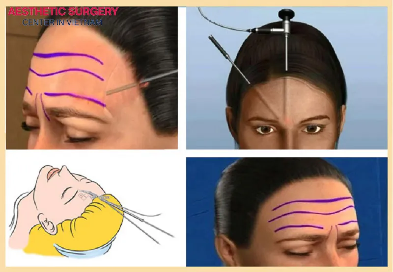 Forehead lift is a fairly complex technique and should be performed by an experienced surgeon.