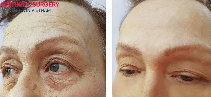Forehead lift helps eliminate all signs of aging on the forehead, giving a more youthful appearance.