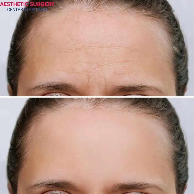 The cost of a forehead lift largely depends on the method used, the degree of forehead aging, and the clinic where it is performed.