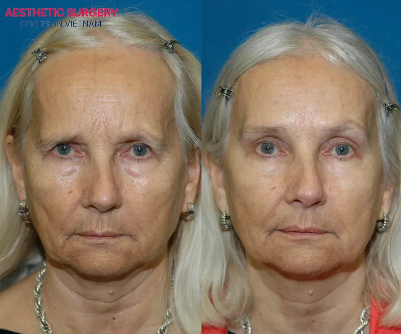 Erase the signs of aging on the forehead to achieve a more youthful appearance.