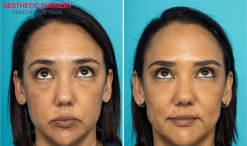The client’s forehead wrinkles were almost completely removed after undergoing a forehead lift at Aesthetic Surgery Center.