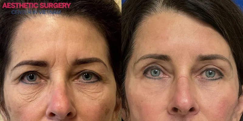Before-and-after photos of clients who had a forehead lift at Aesthetic Surgery Center.