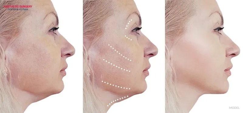 A full facelift is a cosmetic procedure that addresses facial signs of aging by tightening the outer layer of the skin.