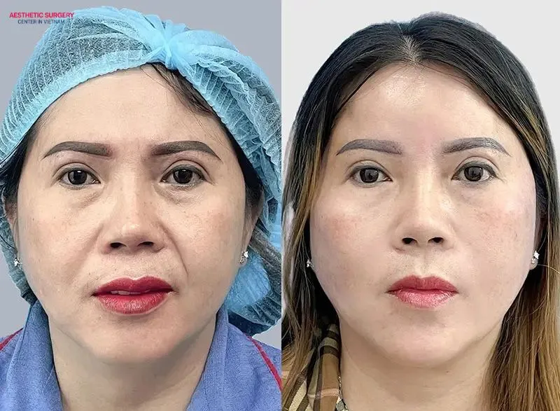 A full facelift provides comprehensive facial rejuvenation and boosts women’s confidence.