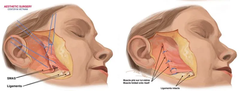 Before a full facelift, the surgeon administers general anesthesia, so the procedure is completely painless.