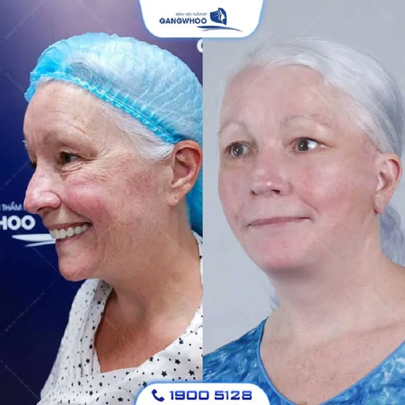The client's face rejuvenated surprisingly after a full facelift at Gangwhoo.
