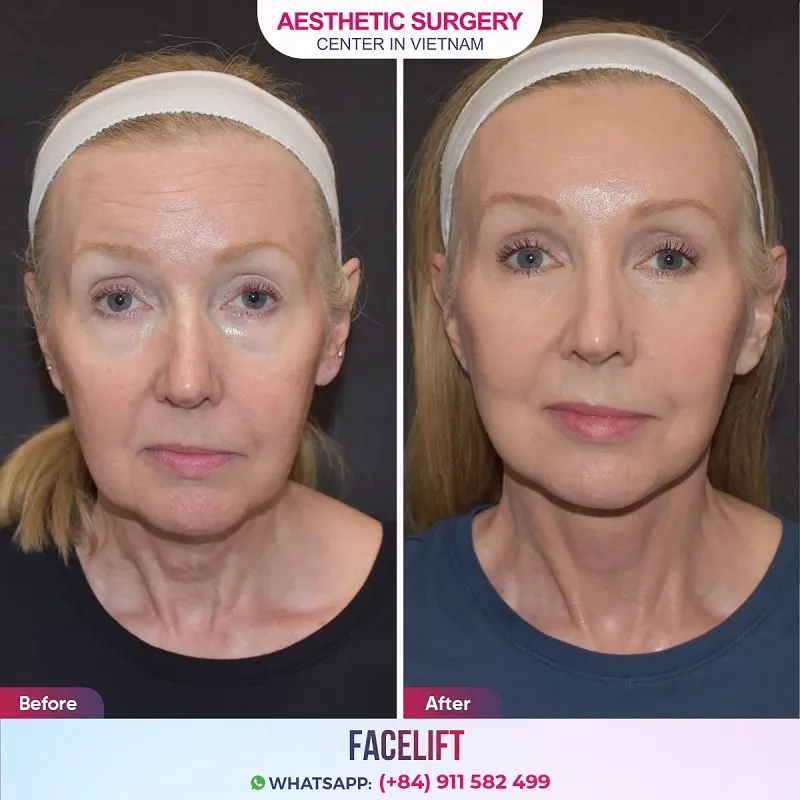 Client images before and after performing a full facelift at Aesthetic Surgery Center