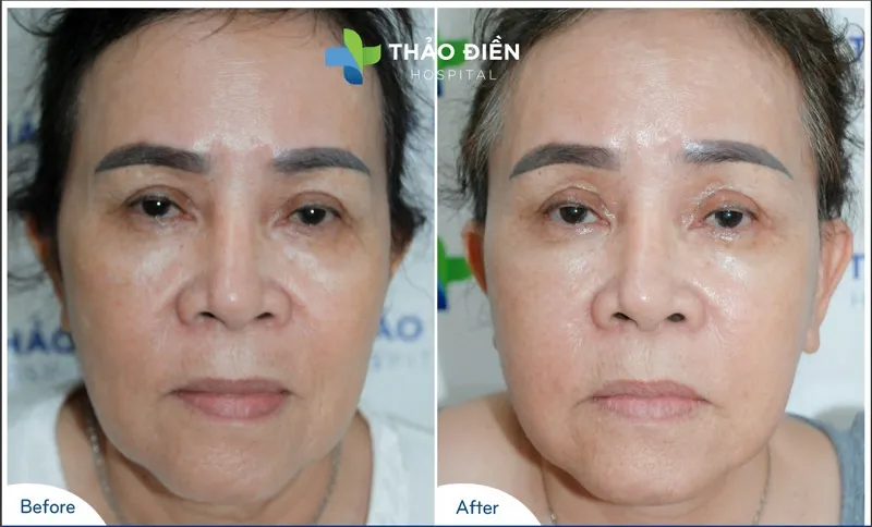 Deep wrinkles and deep smile lines on the face have completely faded after full facelift at Thao Dien Cosmetic Hospital.