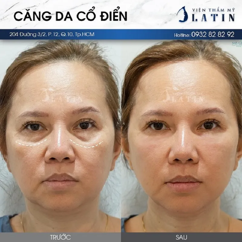 Images before and after full facelift of clients at Latin Aesthetic Institute