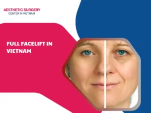Full facelift in vietnam