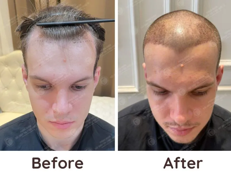 The International Medical Hair Transplant Clinic is a specialized medical center in autologous hair transplantation, helping many clients restore their natural hair.