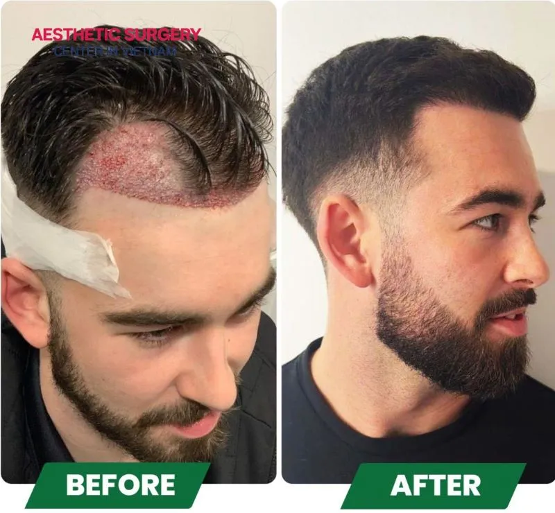 After undergoing a hair transplant at Aesthetic Surgery Center, clients can expect their hair to look thicker, stronger, and healthier once fully recovered.