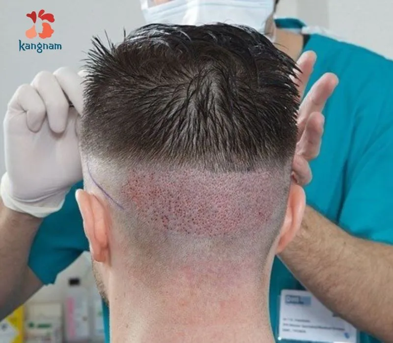Every hair transplant procedure is closely monitored by the surgeons to ensure optimal recovery and strong, healthy hair growth within a few months.