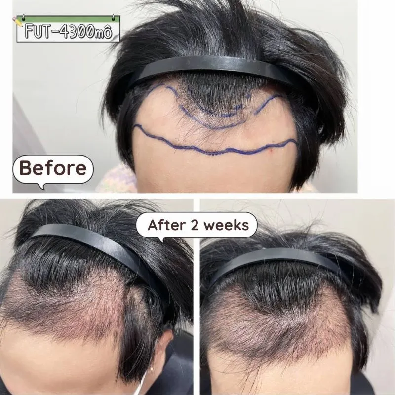 The client’s hair shows noticeable improvement after 2 weeks, appearing thicker and stronger.
