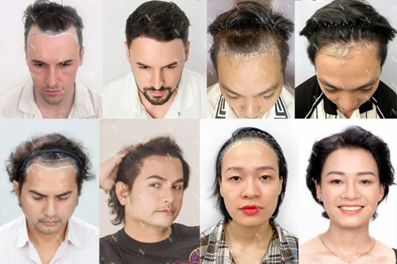 Before-and-after results of both local and international clients after undergoing hair transplantation at NEWHAIR Hair Transplant Institute – Kho Thi.