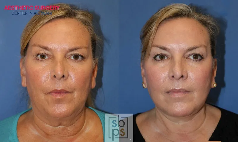 Image of a noticeably younger-looking woman after a facelift