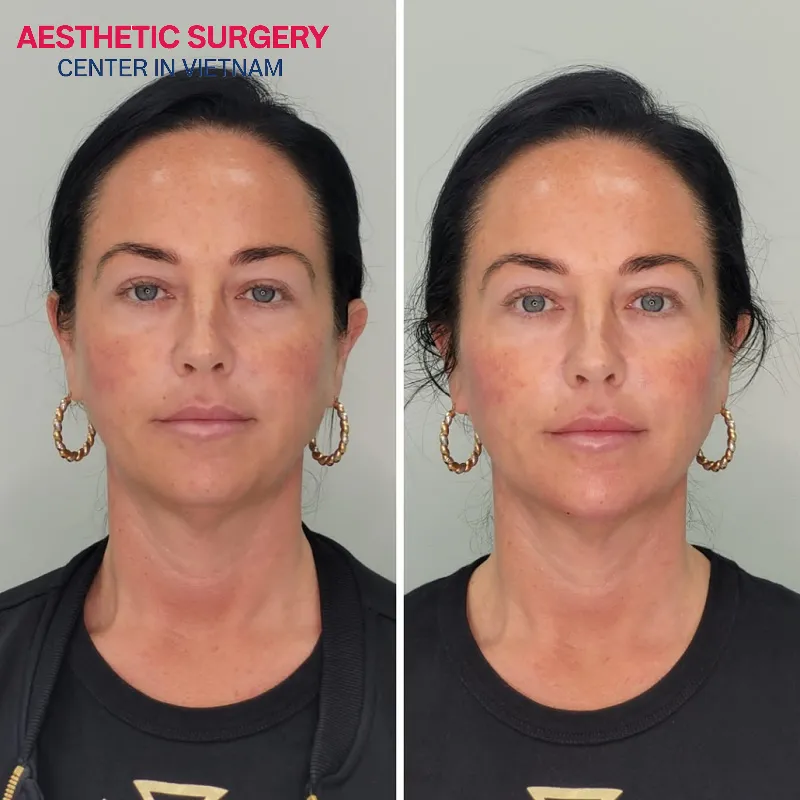 A second facelift helps women maintain a youthful appearance and smooth, firm skin over time.