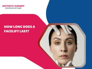 How long does a facelift last?