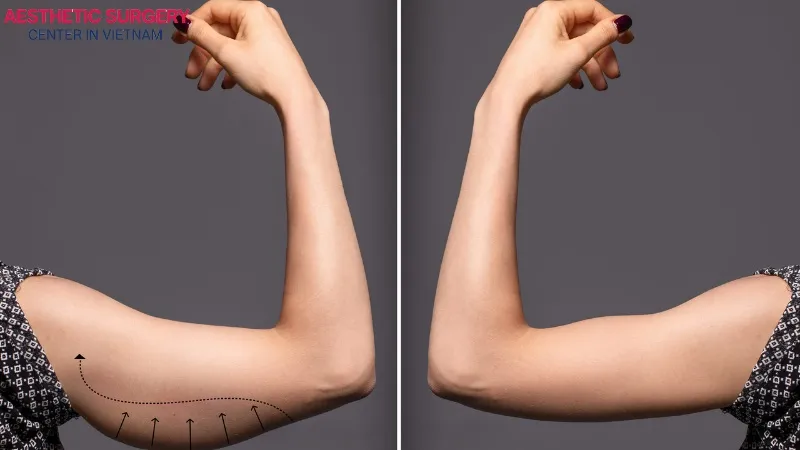 Arm liposuction is a modern cosmetic procedure that is increasingly popular today.