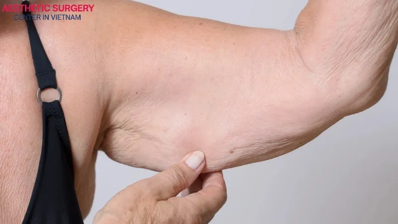 The condition of the arm skin is a factor that affects the cost of arm liposuction.