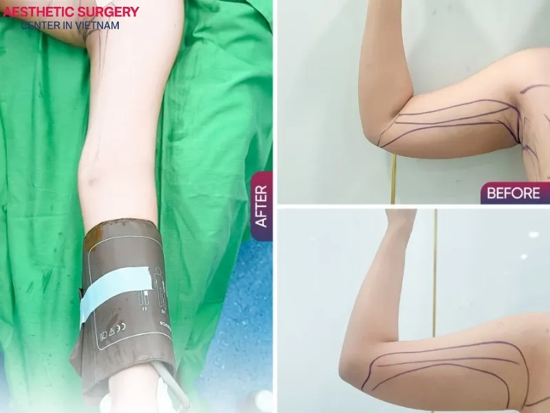 Arms appear noticeably slimmer after arm liposuction at Aesthetic Surgery Center in Vietnam.