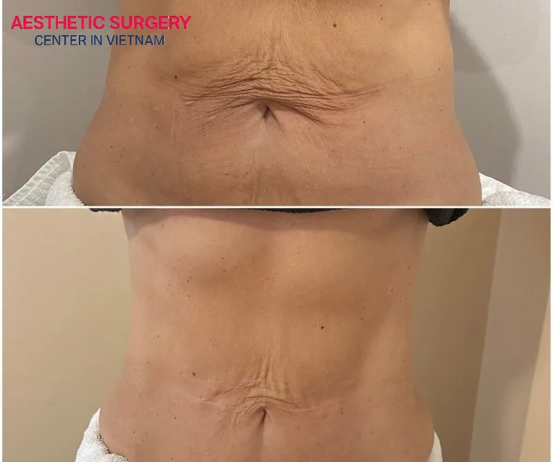 Liposuction is suitable for individuals with good skin elasticity and minimal sagging.