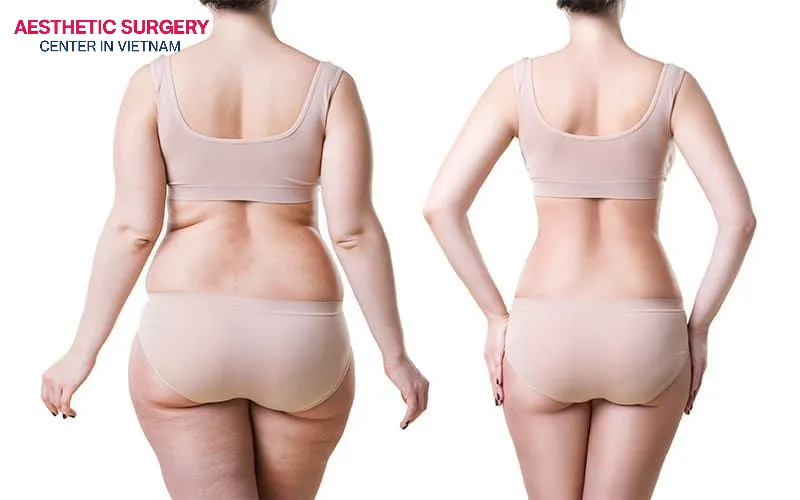 A tummy tuck is a comprehensive procedure that addresses excess fat, sagging skin, and loose abdominal muscles.