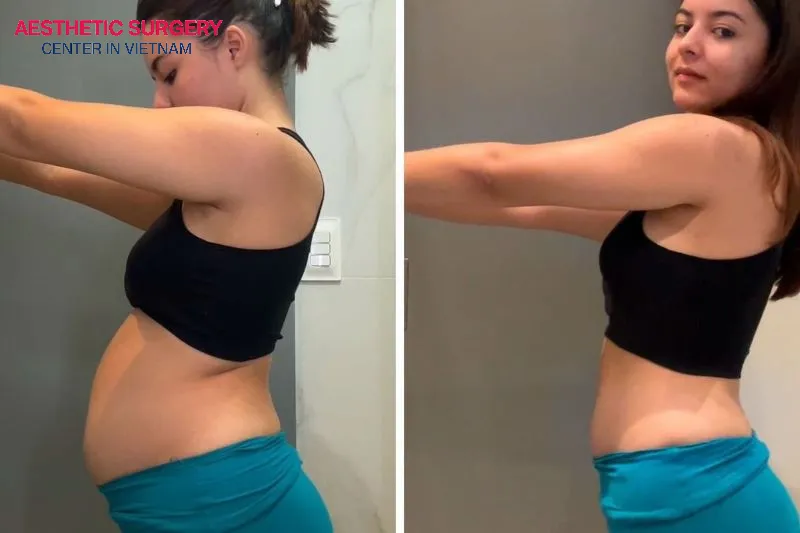 Whether liposuction is better than a tummy tuck depends on your health condition and personal needs.