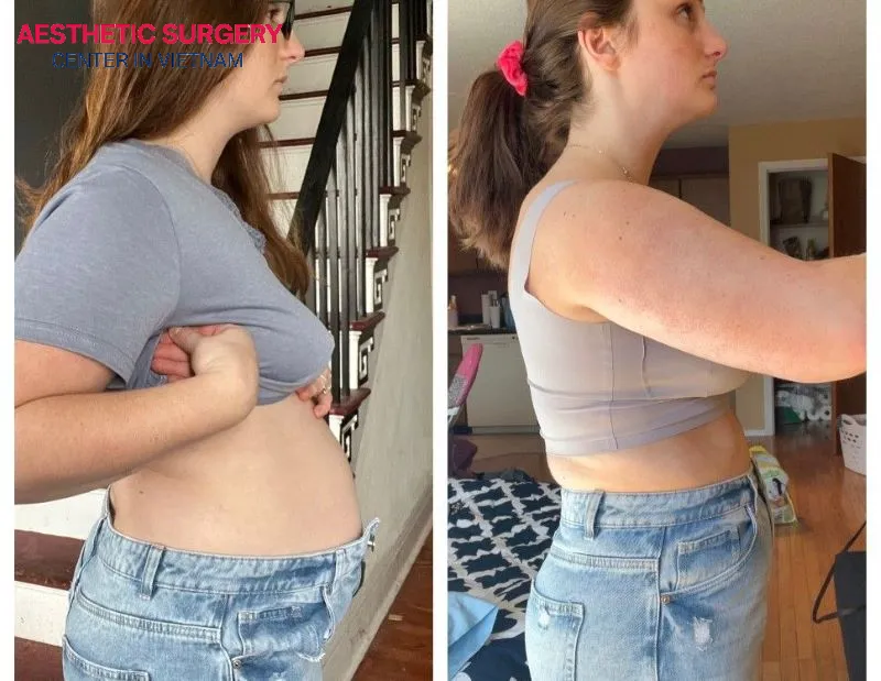 Clients after undergoing liposuction at the Aesthetic Surgery Center in Vietnam