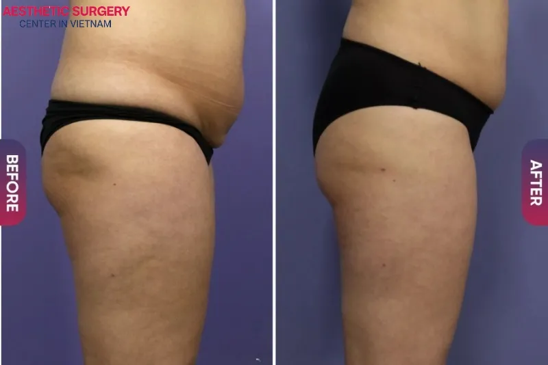 Liposuction at Aesthetic Surgery Center in Vietnam helps the body become firmer and more balanced.