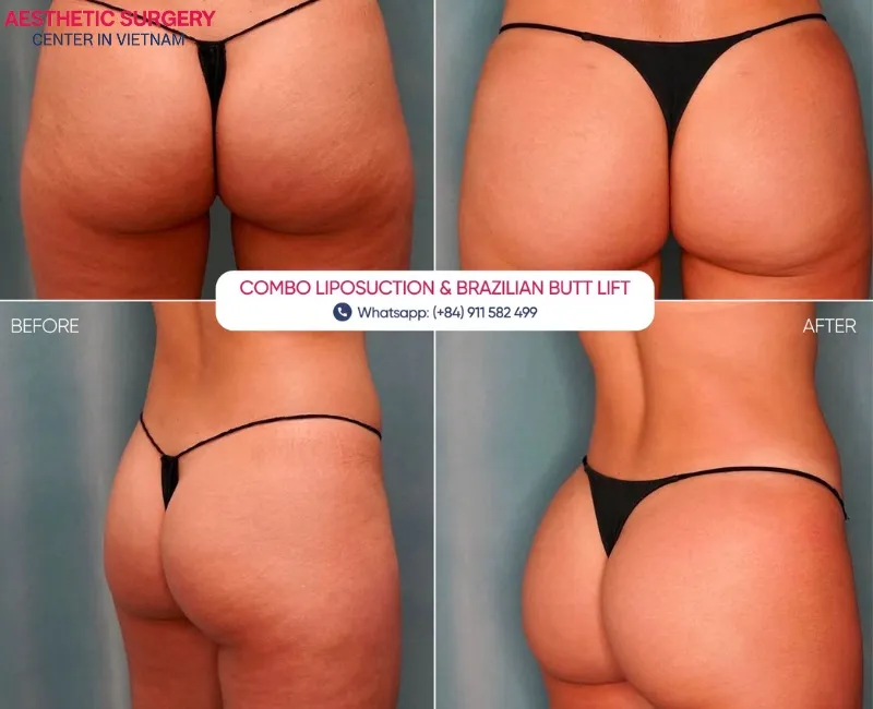 Liposuction and BBL combo at Aesthetic Surgery Center in Vietnam