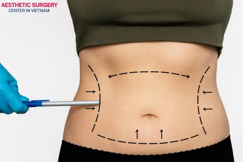 Liposuction helps the body become slimmer, firmer, and more balanced.
