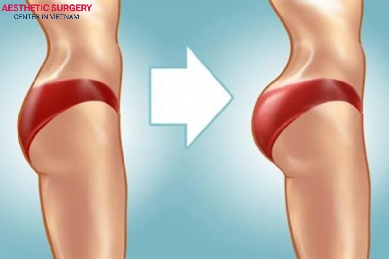 BBL is an advanced cosmetic procedure that enhances the size and shape of the buttocks.