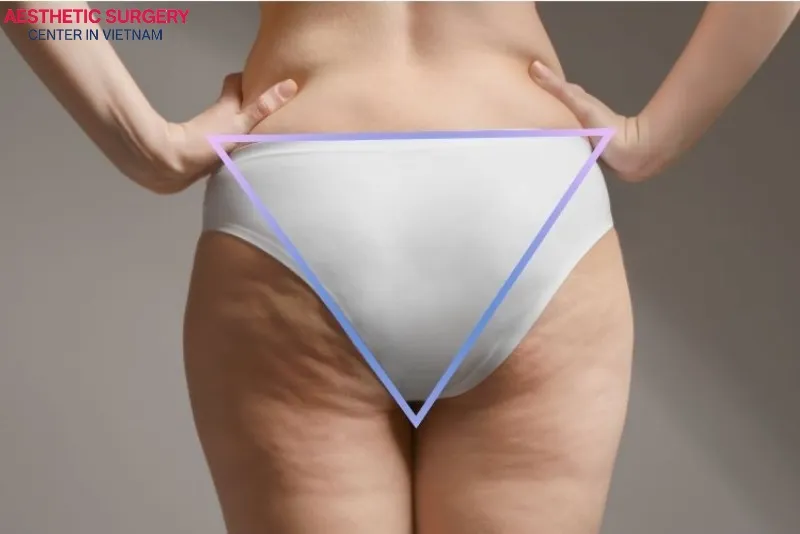 Suitable for individuals who have lost buttock volume or firmness due to aging.