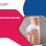 Liposuction and bbl