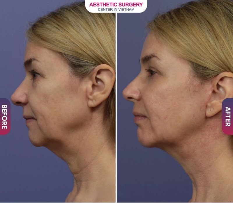 Before and after photos of clients who have undergone a neck lift at Aesthetic Surgery Center.