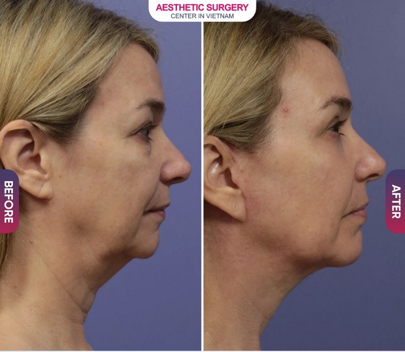 The client's neck skin has significantly reduced wrinkles, regaining smooth, soft, beautiful skin like youthful skin.