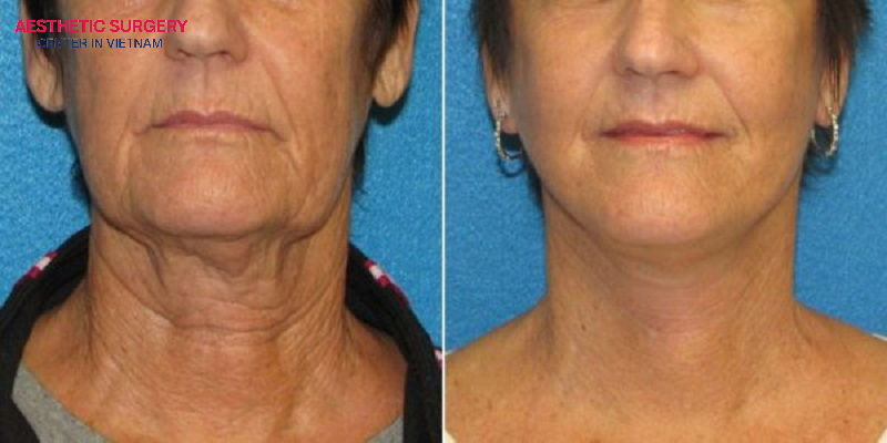 A full neck lift offers many outstanding benefits, including long-lasting results, enhanced contour definition, and significant improvement in visible signs of neck aging.