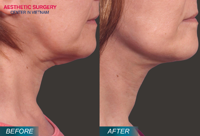 The before and after photos of the client clearly show the remarkable effectiveness of the neck lift procedure.