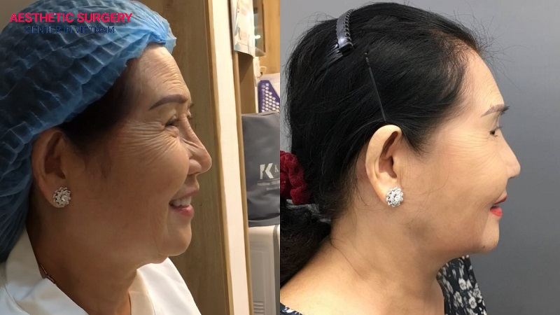The noticeable improvement in the client’s neck after a full neck lift is clearly visible.