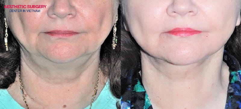 The dramatic transformation of the client’s neck after undergoing a full facelift is truly impressive.