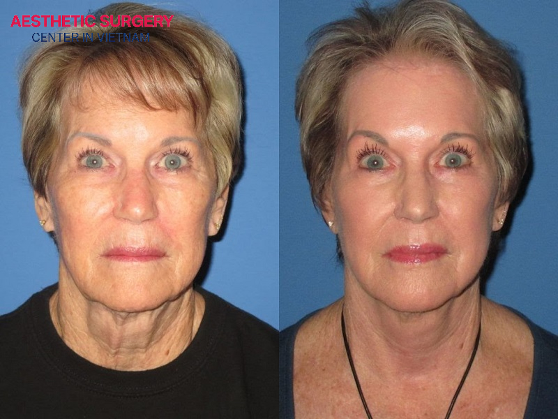 The client’s neck skin becomes smoother, firmer, and more elastic, with visibly reduced wrinkles after undergoing a neck lift.