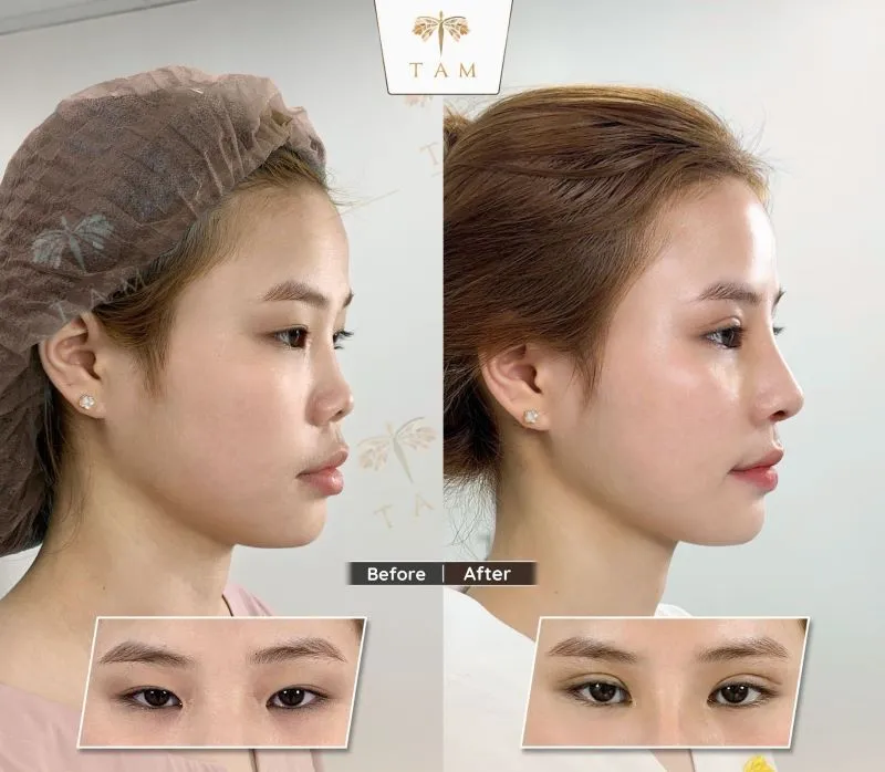 Beauty Center – by Tam focuses on investing in its team of doctors to deliver elegant, natural-looking nose shapes that last for many years.