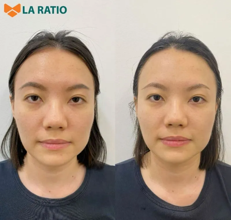 The Patient’s nose results after rhinoplasty at La Ratio Beauty Salon