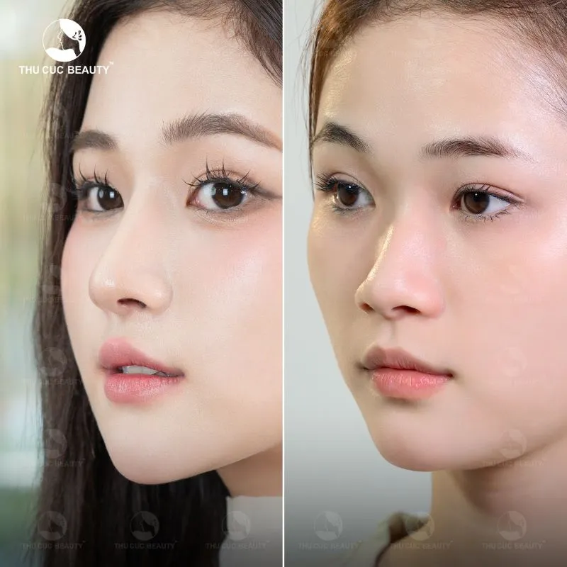 Enhancing clients’ appearance, helping them feel confident with their new nose shape for years after rhinoplasty in Vietnam.