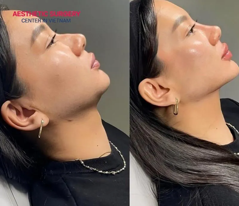 After undergoing rhinoplasty in Vietnam at Aesthetic Surgery Center, the client’s nose appears more elegant and harmoniously balanced with their facial features.